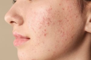 Cách chăm sóc da mụn đúng cách tại nhà – Hướng dẫn chi tiết cho làn da khỏe đẹp